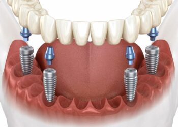 Имплантация All on X: понятие и ключевые достоинства процедуры